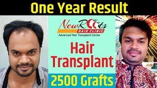 Best Hair Transplant Result 2019 | New Roots Hair Transplant | Fue technique