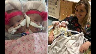 Weeks After These Conjoined Twins Were Born, The Parents Were Forced To Make An Impossible Decision