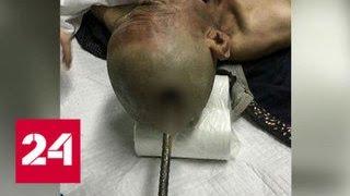 В Китае строитель выжил после того, как его голову пробил металлический прут - Россия 24